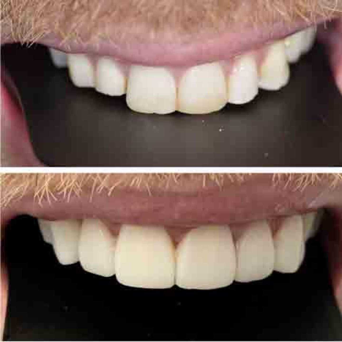 Composite Bonding Gallery Composite Bonding Gallery